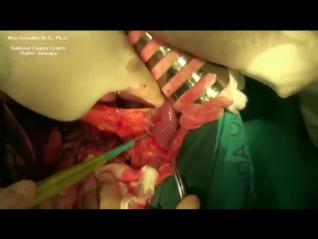Radical D2 Gastrectomy with Roux-en-Y reservoir