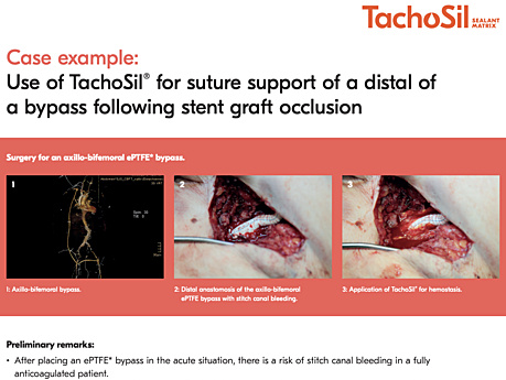 Use of TachoSil® for Suture Support of a Distal of a Bypass Following Stent Graft Occlusion, Prof. Thomas Hölzenbein