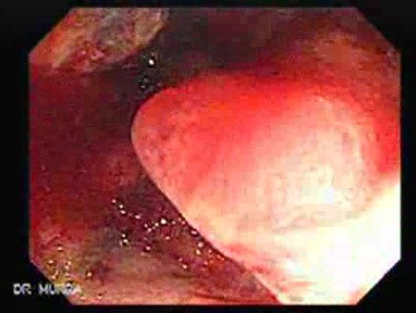 Rectum Adenocarcinoma (2 of 4)