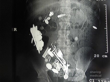 Multiple Foreign bodies in the GI tract (2 of 12)