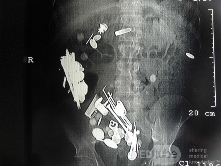 Multiple Foreign bodies in the GI tract (2 of 12)