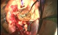The Technique of Aortic Root Replacement