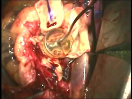The Technique of Aortic Root Replacement