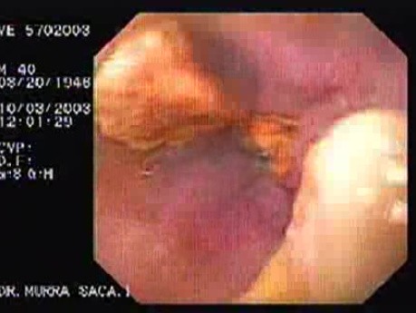 Acute Variceal Bleeding - Necrotic Varices After Ligation, Part 2