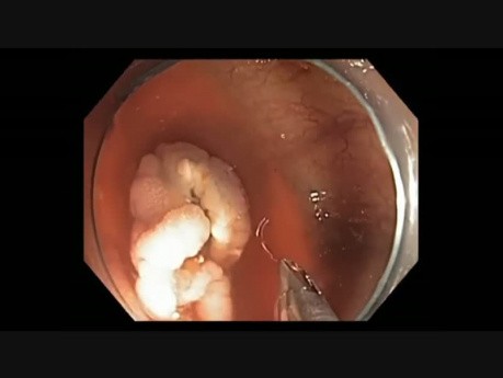 Colonoscopy Channel - EMR Closure 3