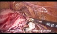 Goel's Technique of Laparoscopic Hysterectomy for Carcinoma Endometrium