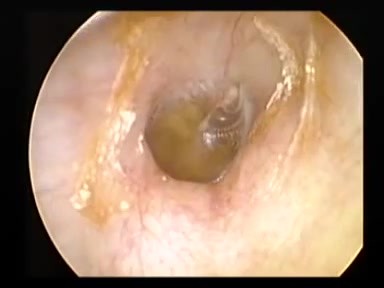 Middle Ear Effusion 
