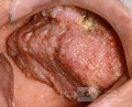 Verrucous CarcInoma of the Palate