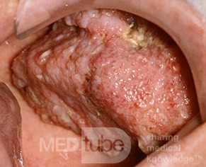 Verrucous CarcInoma of the Palate