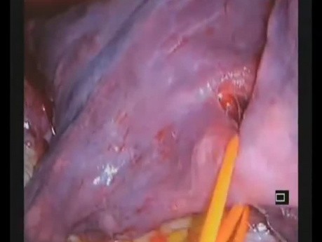 Uniportal VATS Bilobectomy and Superior Lower Lobe Segmentectomy