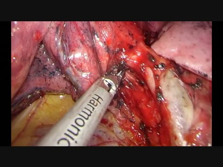 Uniportal VATS left upper lobectomy