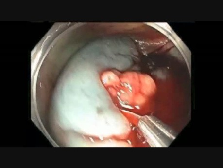 Colonoscopy Channel Quiz 10