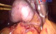 Total Laparoscopic Hysterectomy in Case of Advanced Endometriosis