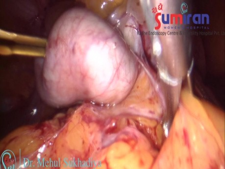 Total Laparoscopic Hysterectomy in Case of Advanced Endometriosis