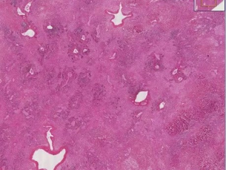 Fulminant hepatitis