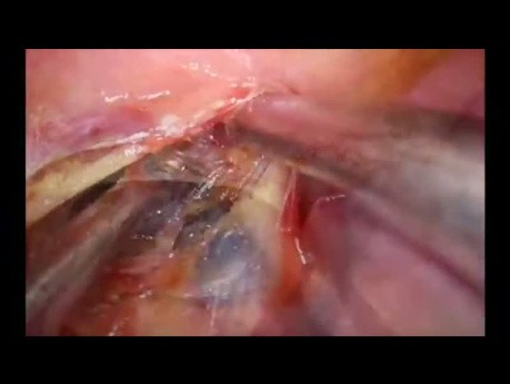 Uniportal VATS Lymph Node Dissection on the Left Side