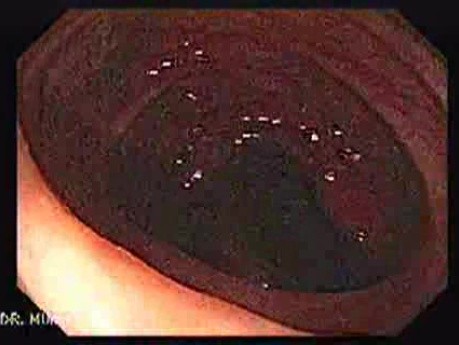 Colonic Tuberculosis Mimicking Crohn's Disease (3 of 12)