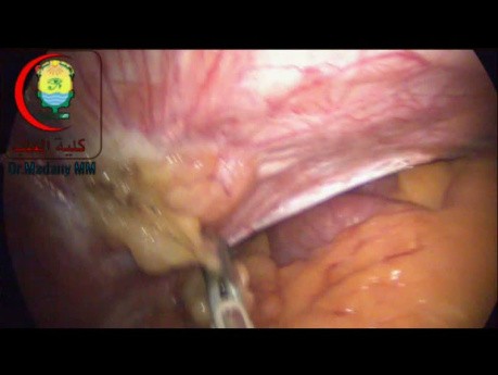 Adhesiolysis to be Done or Not 