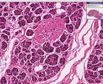 Pancreas- Hyalinized Islets