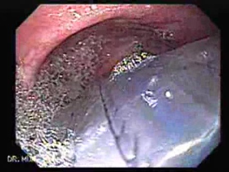 Esophagus - Pneumatic Dilation for Achalasia - Insertion of the Dilator