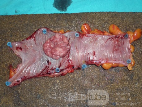 Colon Adenocarcinoma, Villous Adenocarcinoma (10 of 12)