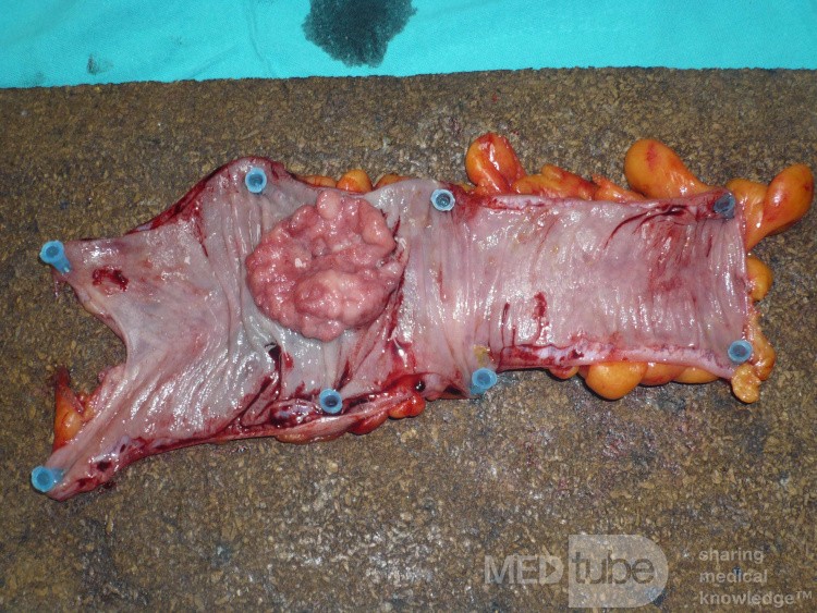 Colon Adenocarcinoma, Villous Adenocarcinoma (10 of 12)