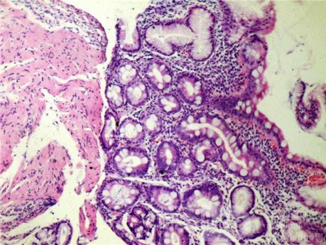 Intestinal Metaplasia (4 of 5)