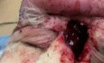 Subgaleal Abscess
