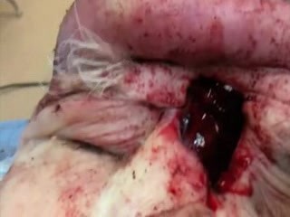 Subgaleal Abscess