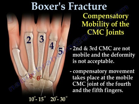 Boxer's Fracture - Video Lecture