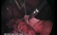 Nissen Fundoplication