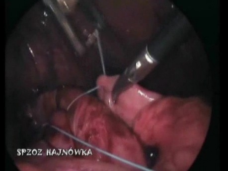 Nissen Fundoplication