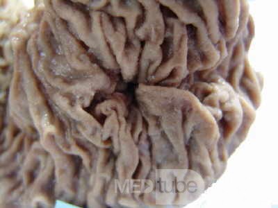Cholangiocarcinoma that infiltrated a Periampullary Duodenal Diverticula and the head of the pancreas (7 of 20)