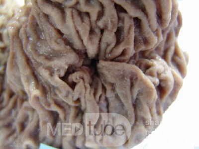 Cholangiocarcinoma that infiltrated a Periampullary Duodenal Diverticula and the head of the pancreas (7 of 20)