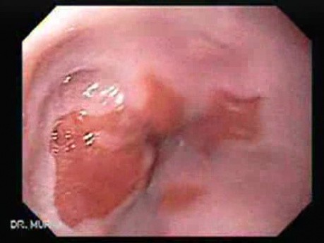 Barrett Esophagus - Endoscopic Far-Away View