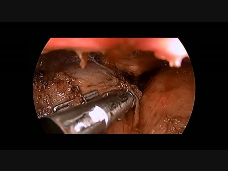 Thoracoscopic Thymectomy in Child