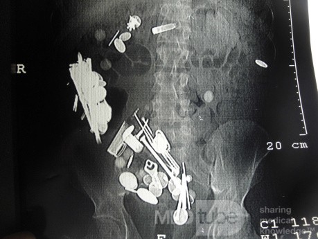 Multiple Foreign bodies in the GI tract (3 of 12)