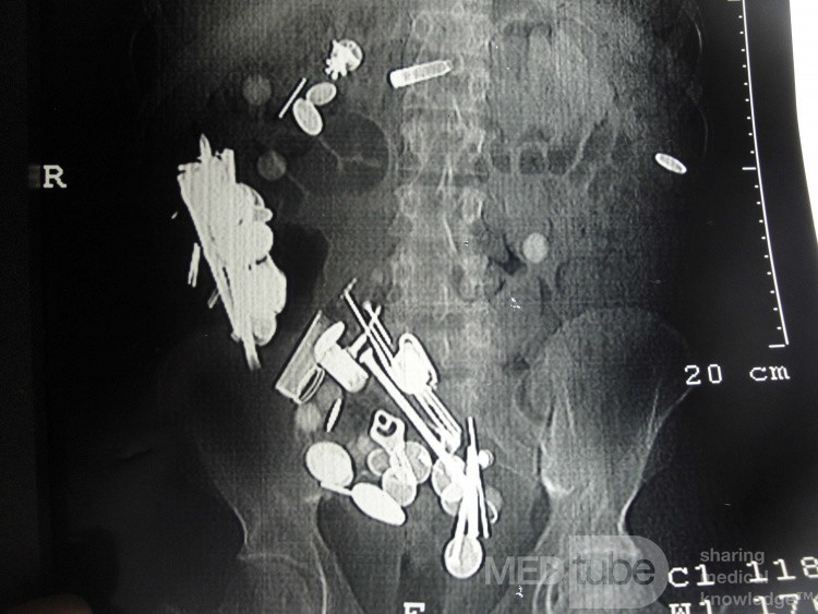 Multiple Foreign bodies in the GI tract (3 of 12)