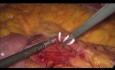Laparoscopic Sigmoid Resection Due to Cancer
