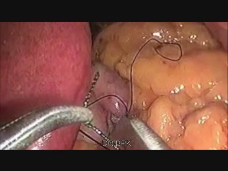 Laparoscopic Mini Gastric Bypass