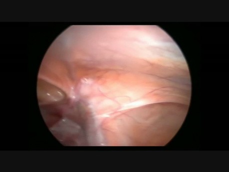 Diagnosic LAP IUD in Omentum