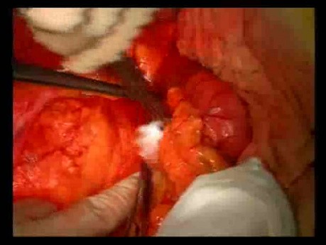 Open Right Hemicolectomy – Technical Principles - Operation No 1B - Part 2