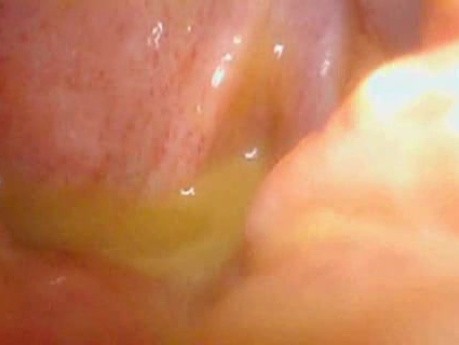 Colonic Perforation With Peritonitis - Laparoscopy (24 of 46)