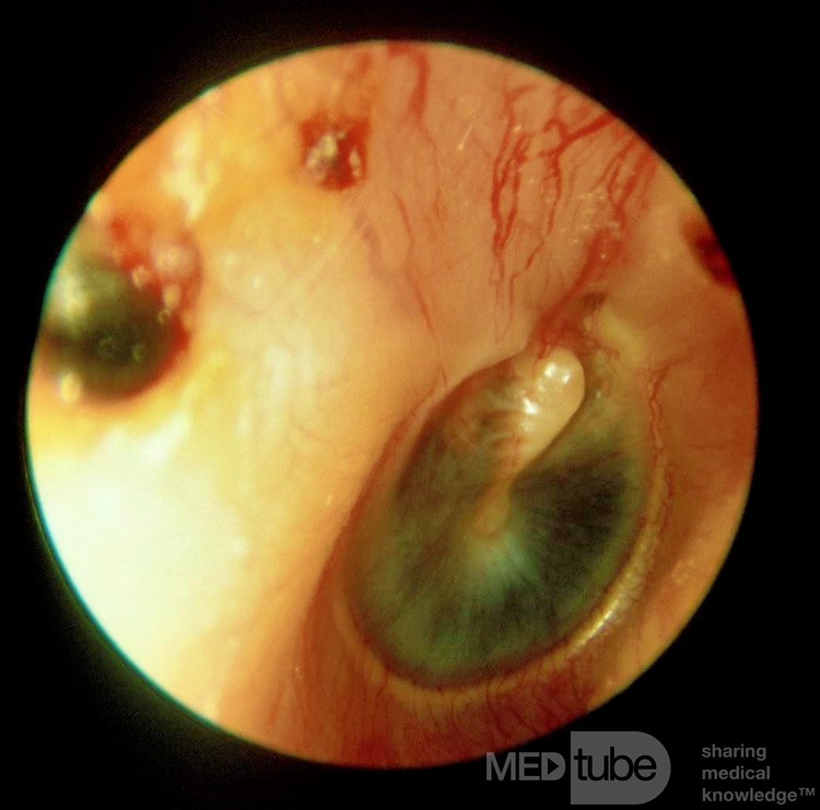Bullous Myringitis with Hemotympanum