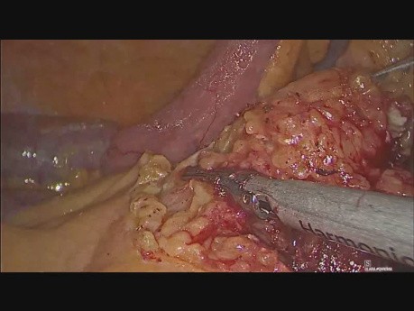 Laparoscopic Small Bowel and Mesentry Resection for Adenocarcinoma