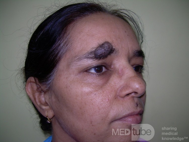 Large Black Mole- Melanoma Malignum