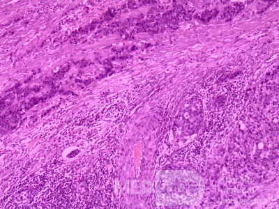 Gallbladder Adenocarcinoma and litiasis (8 of 13)
