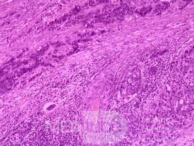 Gallbladder Adenocarcinoma and litiasis (8 of 13)