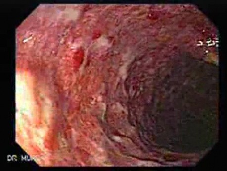 Colonic Lymphoma (5 of 6)