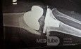 Aseptic Loosening with Distal Femur Bone Loss 